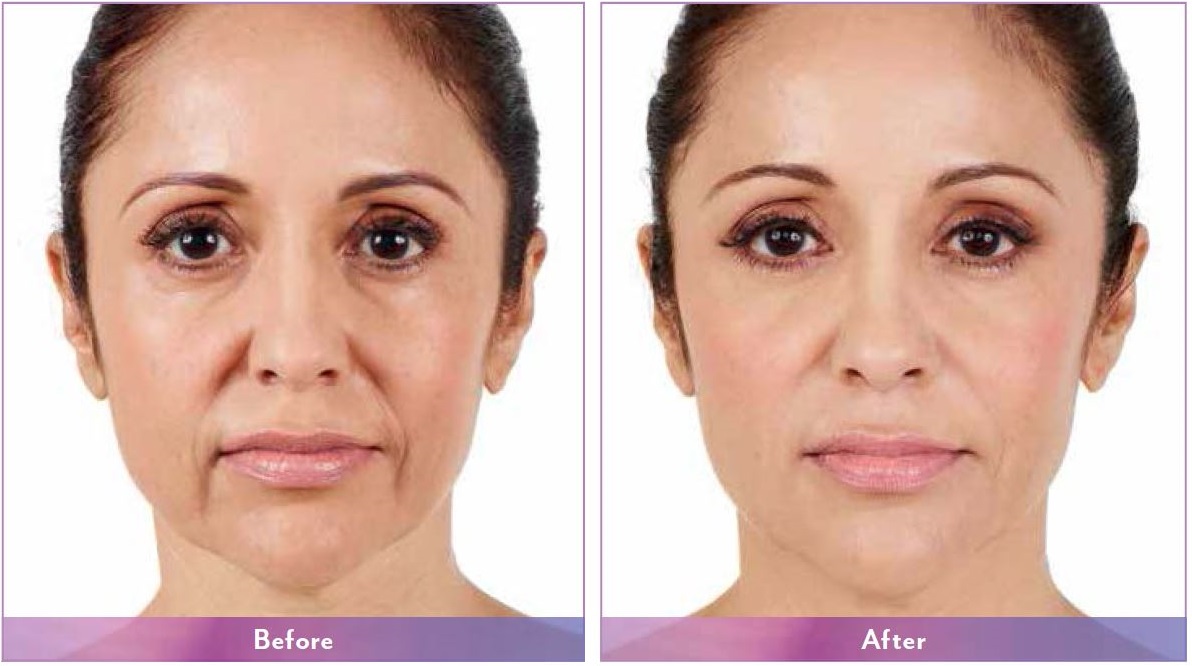 Juvederm Range, Botox, Dermal Fillers - Richmond cosmetic clinic